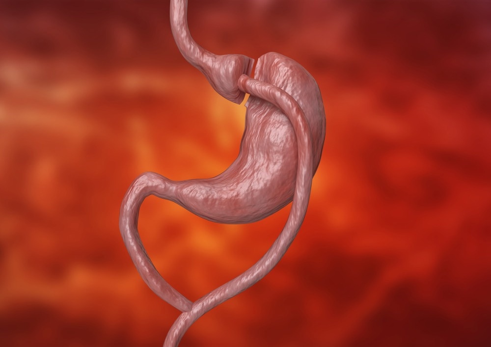 Study: Gastric Bypass vs Diet and Cardiovascular Risk Factors A Nonrandomized Controlled Trial. Image Credit: Adao/Shutterstock.com