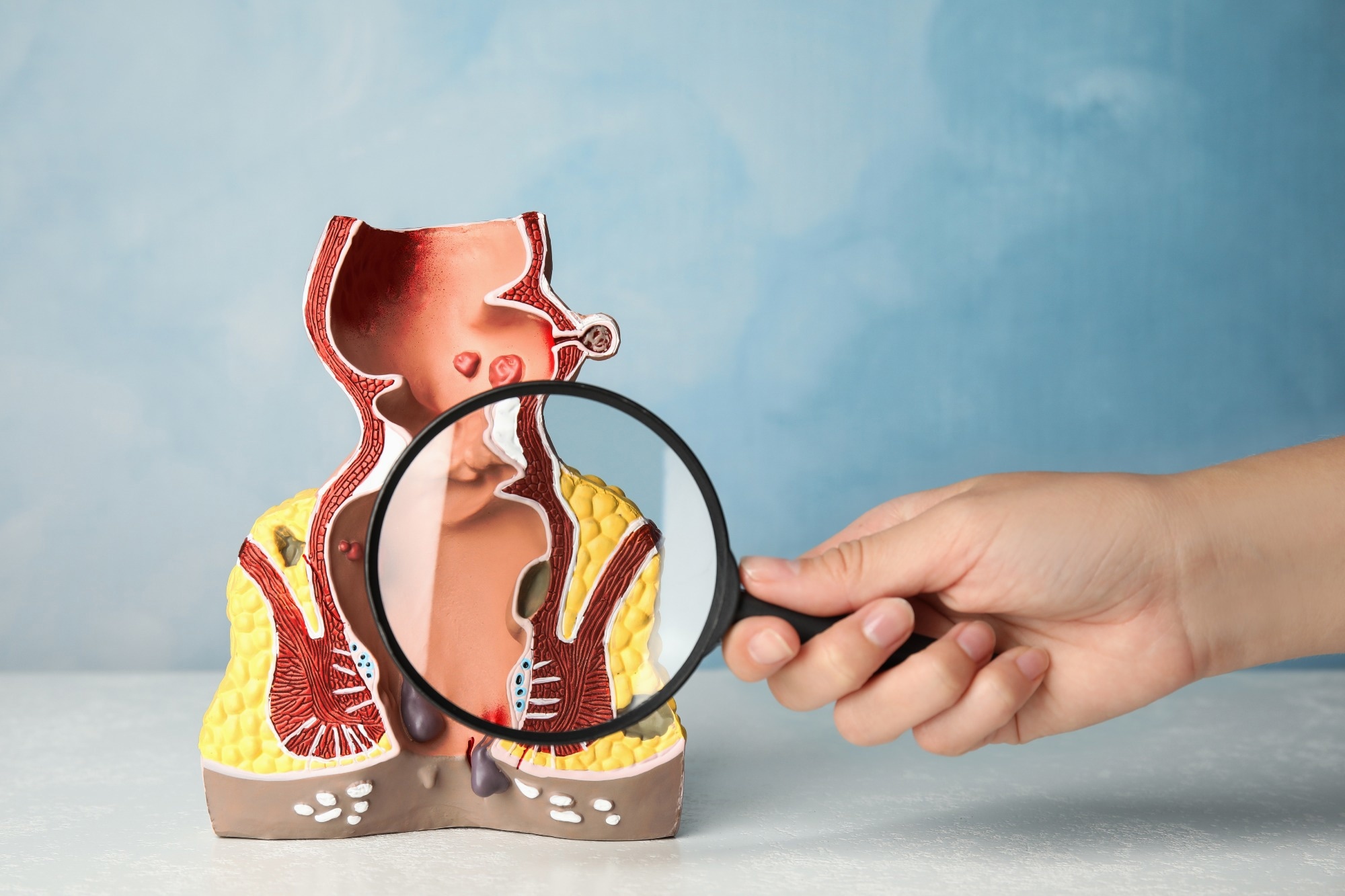 Study: Total neoadjuvant treatment using short-course radiotherapy and four CAPOX cycles in locally advanced rectal cancer with high-risk criteria for recurrence: a Swedish nationwide cohort study (LARCT-US). Image Credit: New Africa/Shutterstock.com