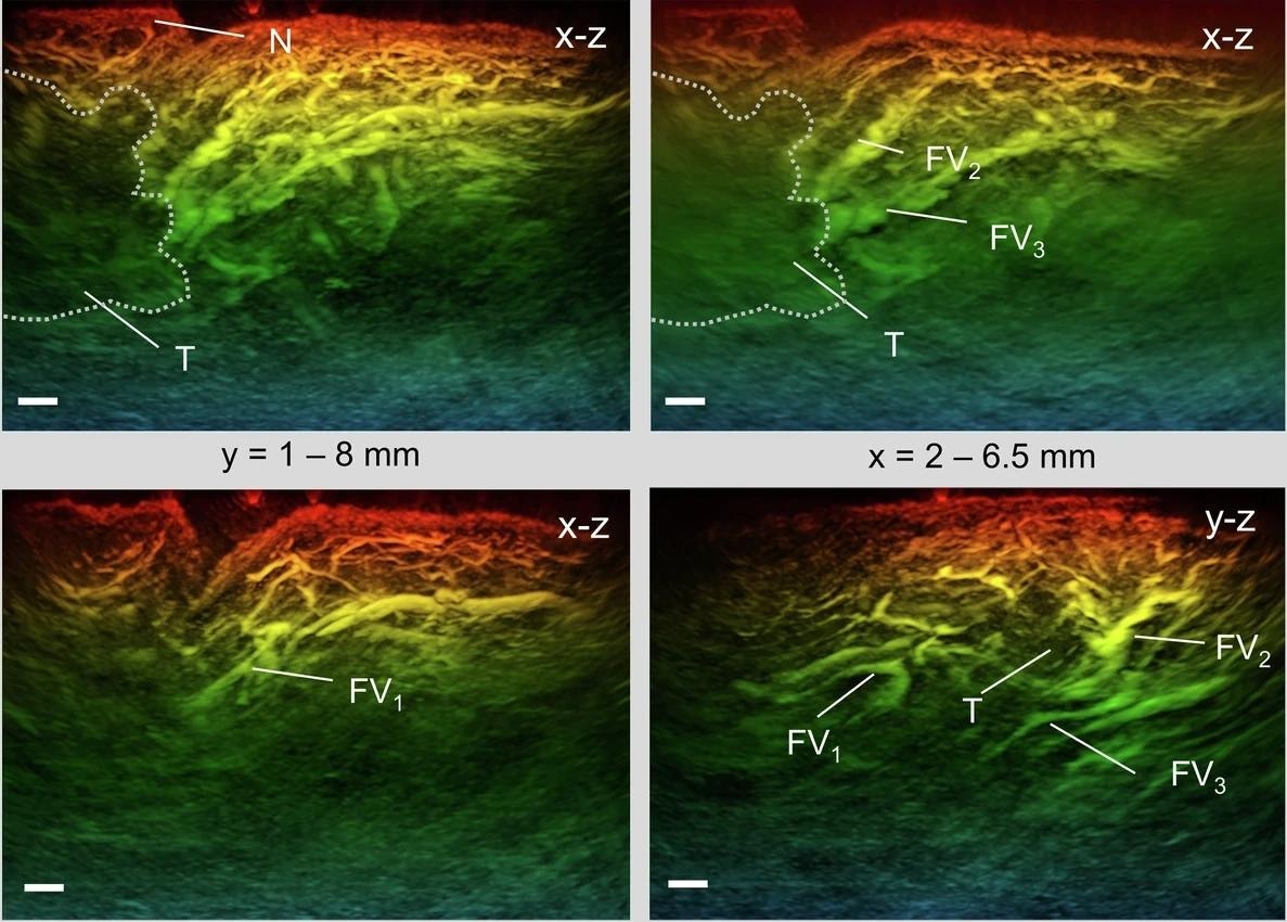 Study: A fast all-optical 3D photoacoustic scanner for clinical vascular imaging