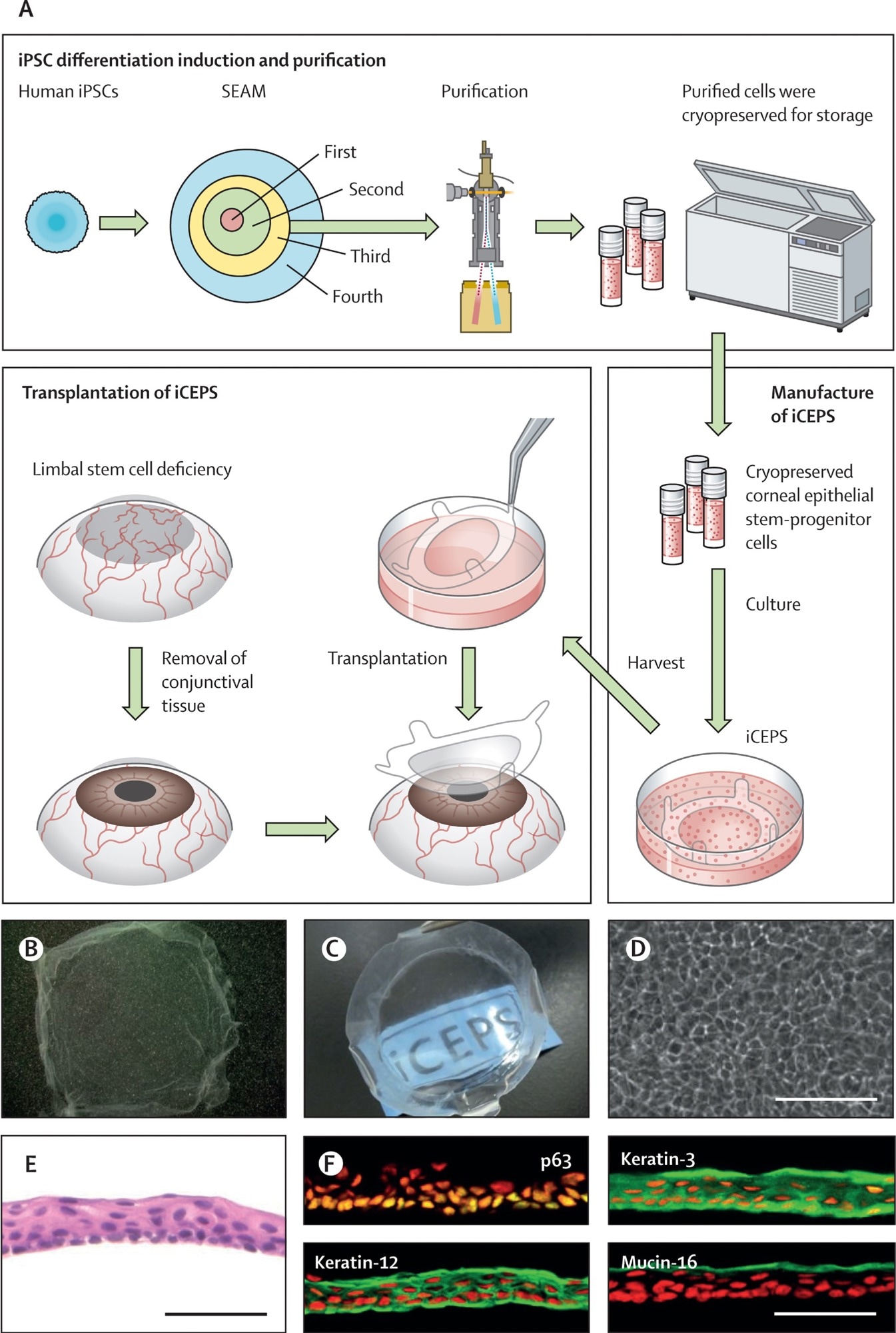 (A) A schematic of the whole procedure, starting with the cultivation of human iPSCs into SEAMs and the subsequent purification of corneal epithelial stem–progenitor cells from the third zone of the SEAM by means of a cell sorter. These cells were cryopreserved before their fabrication into iCEPSs at a good gene, cellular, and tissue-based products manufacturing practice-grade facility, and the subsequent transplantation of iCEPS onto affected eyes after removal of conjunctival tissue in patients with an LSCD. (B, C) Macrophotographs of iCEPSs before engraftment showing their transparent nature, with the text “iCEPS” visible below the construct. (D) Cobblestone-like appearance of cells in an iCEPS imaged by phase contrast microscopy. Scale bar, 100 μm. (E) iCEPSs are made up of three to five cell layers and resemble the normal corneal epithelium on haematoxylin and eosin staining. Scale bar, 50 μm. (F) iCEPSs are immunostained green and positive for p63, keratin-12, keratin-3, and mucin-16, identifiers of the corneal epithelium; the nuclei are shown in red. Scale bar, 50 μm.