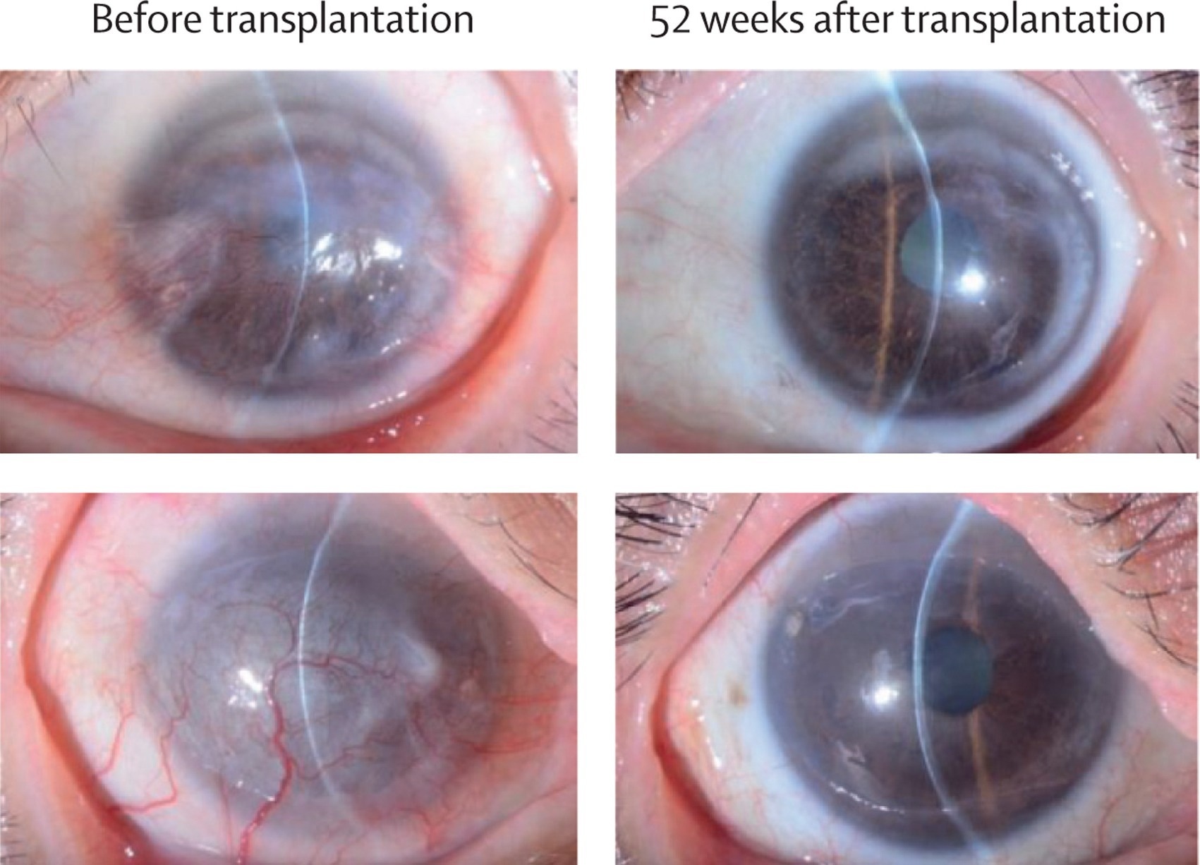 Slit-lamp microscopic photographs of all four treated eyes before and 52 weeks after induced pluripotent stem cell-derived corneal epithelial cell sheet transplantation