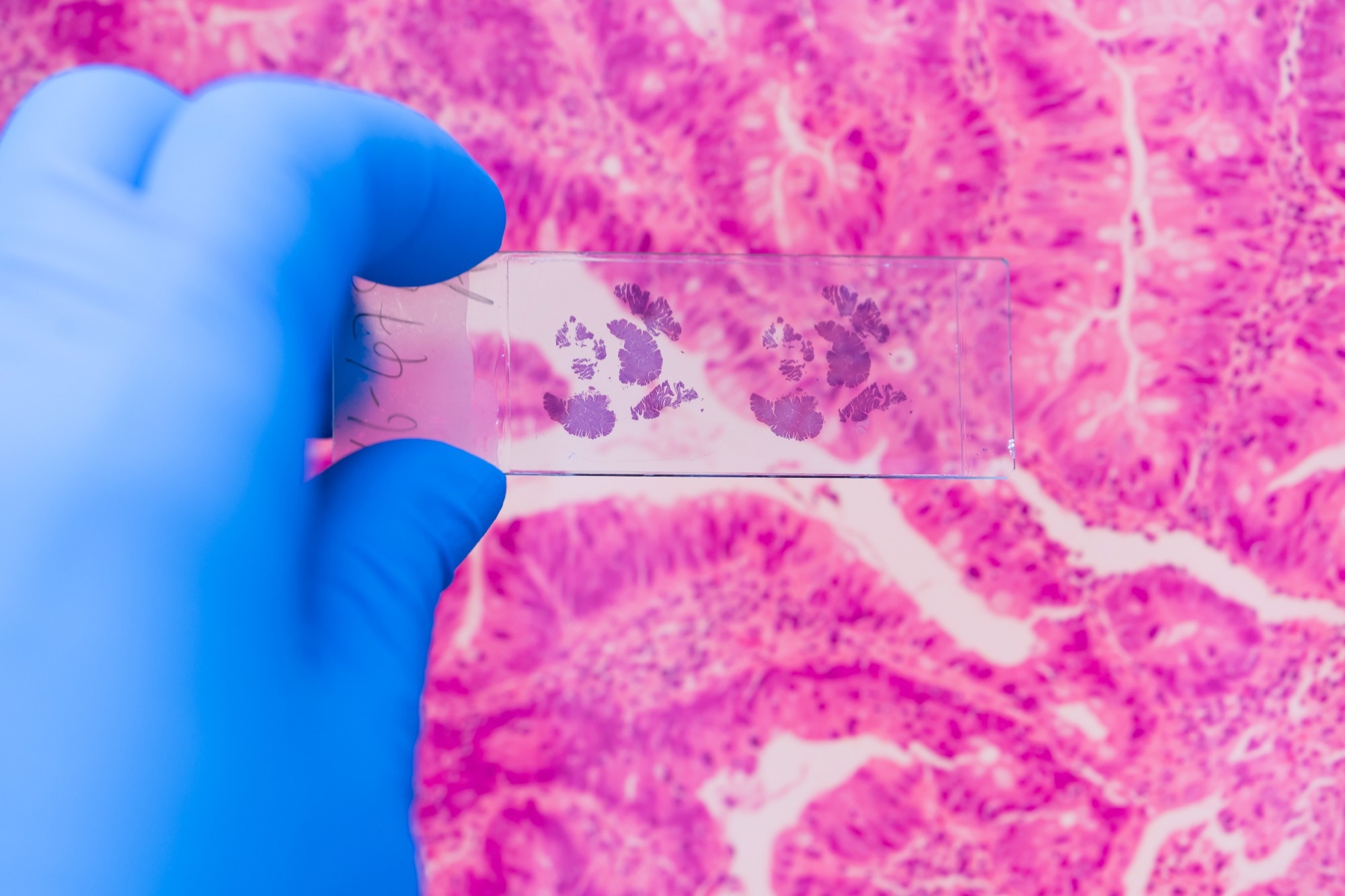 Scientist in blue gloves hand holding glasses slide breast tissue on out of focus cancer tissue picture background.