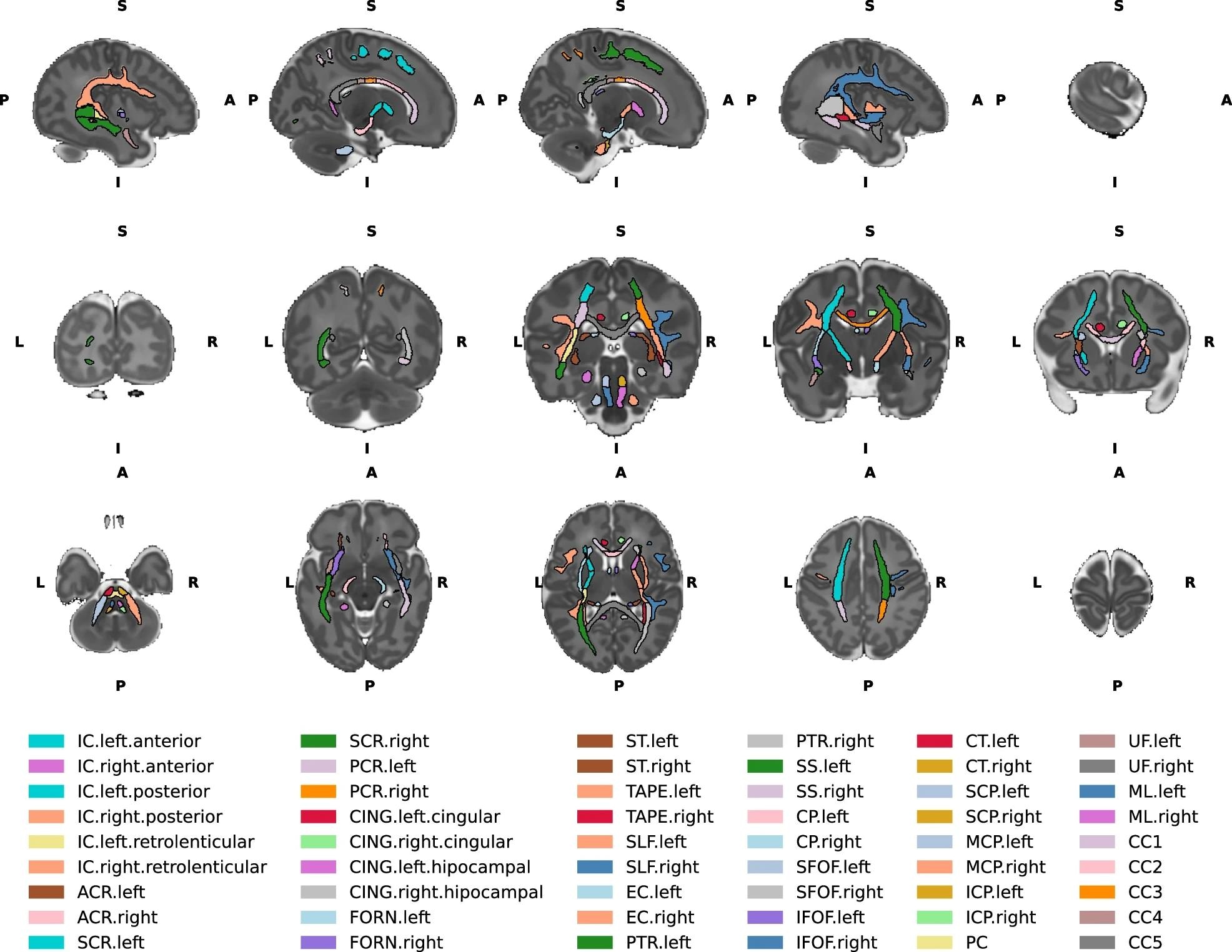 Top row - Left to right sagittal view of the brain slices. Middle row- Posterior to anterior coronal view of the brain slices. Bottom row - Inferior to superior axial view of the brain slices. IC internal capsule, ACR anterior corona radiata, SCR superior corona radiata, PCR posterior corona radiata, CING cingulum, FORN fornix, ST stria terminalis, SLF superior longitudinal fasciculus, EC external capsule, PTR posterior thalamic radiation, SS sagittal stratum, CP cerebral peduncle, SFOF superior fronto-occipital fasciculus, IFOF inferior fronto occipital fasciculus, CT corticospinal tract, SCP superior cerebellar peduncle, MCP middle cerebellar peduncle, ICP inferior cerebellar peduncle, PC pontine crossing, UF uncinate fasciculus, ML medial lemniscus, CC1 corpus callosum prefrontal part, CC2 premotor/supplementary motor part, CC3 corpus callosum motor part, CC4 corpus callosum sensory part, CC5 corpus callosum parietal/temporal/occipital part. L- left, R- right, A- anterior, P- posterior, S- superior, I- inferior.