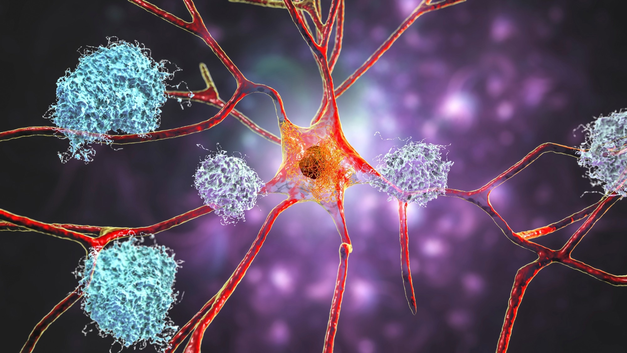 Study: Longitudinal analysis of a dominantly inherited Alzheimer disease mutation carrier protected from dementia. Image Credit: Kateryna Kon / Shutterstock