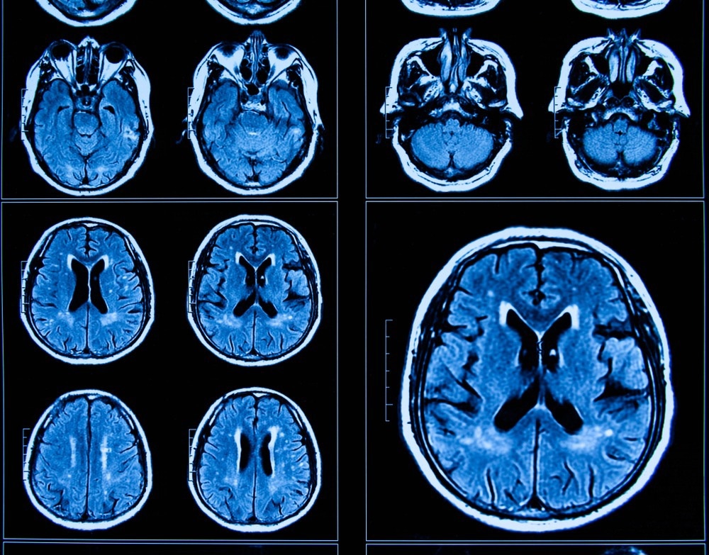 Study: Effects of the COVID-19 Pandemic on Mental Health and Brain Maturation in Adolescents: Implications for Analyzing Longitudinal Data. Image Credit: Shan_shan / Shutterstock.com