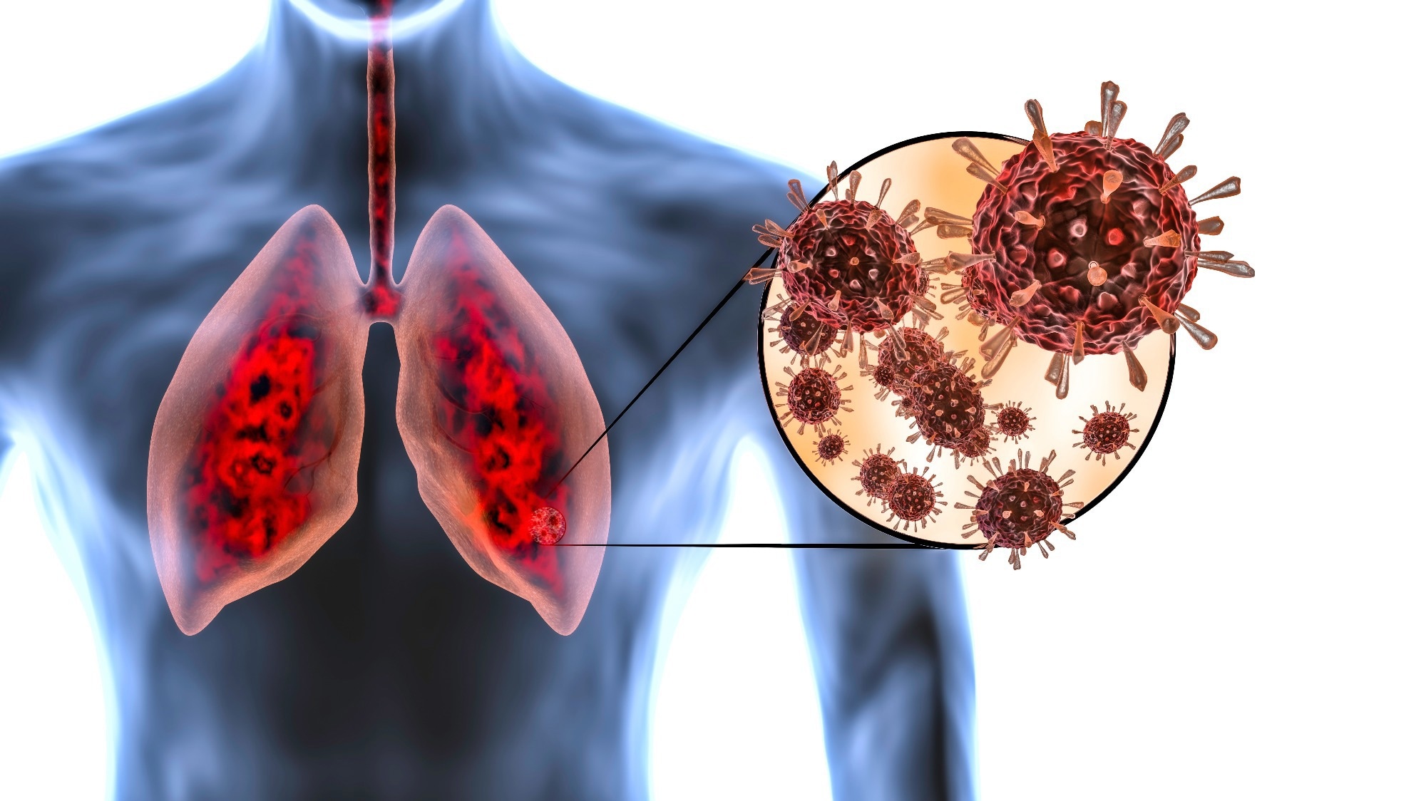 Study: A persistent neutrophil-associated immune signature characterizes post–COVID-19 pulmonary sequelae. Image Credit: MarcinWojc / Shutterstock