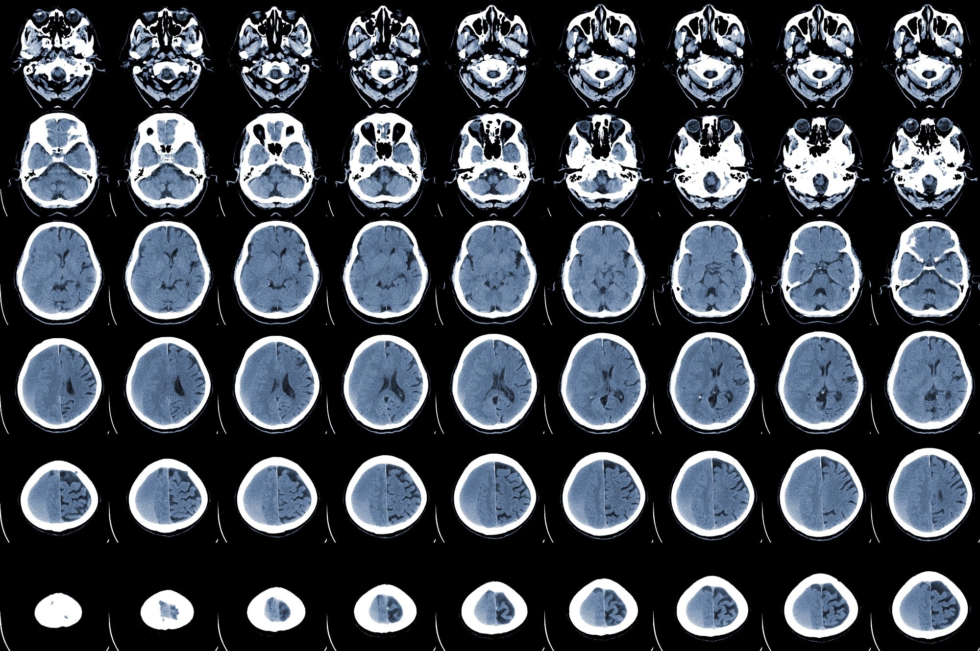 Study: The impact of SARS-CoV-2 infection on the outcome of acute ischemic stroke—A retrospective cohort study. Image Credit: April stock / Shutterstock