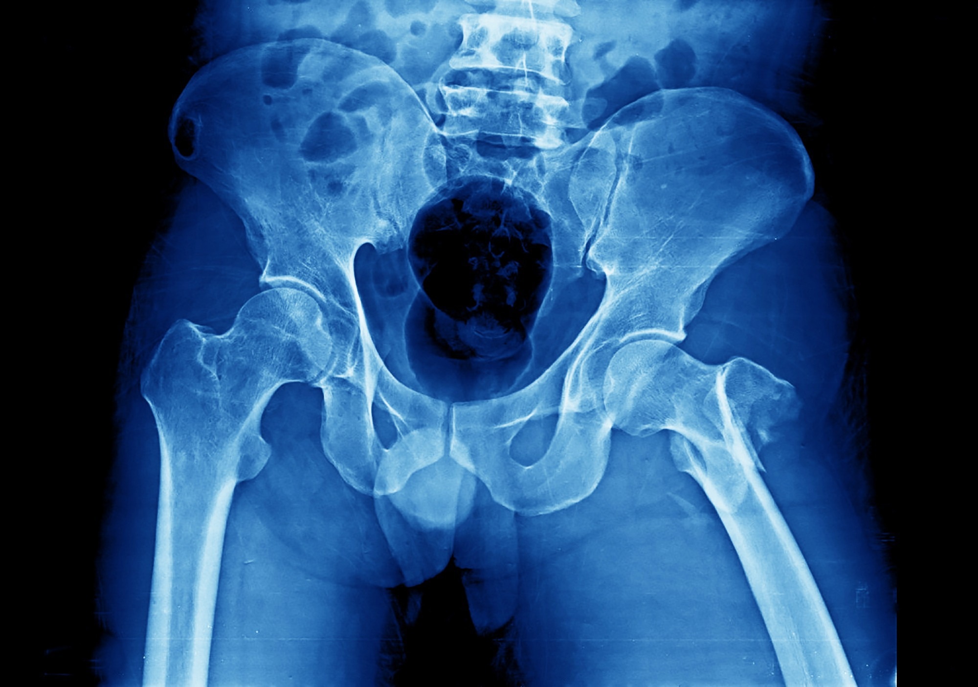 ​​​​​​​Study: ‘Skeletal Age’ for mapping the impact of fracture on mortality. ​​​​​​​Image Credit: Yok_onepiece / Shutterstock