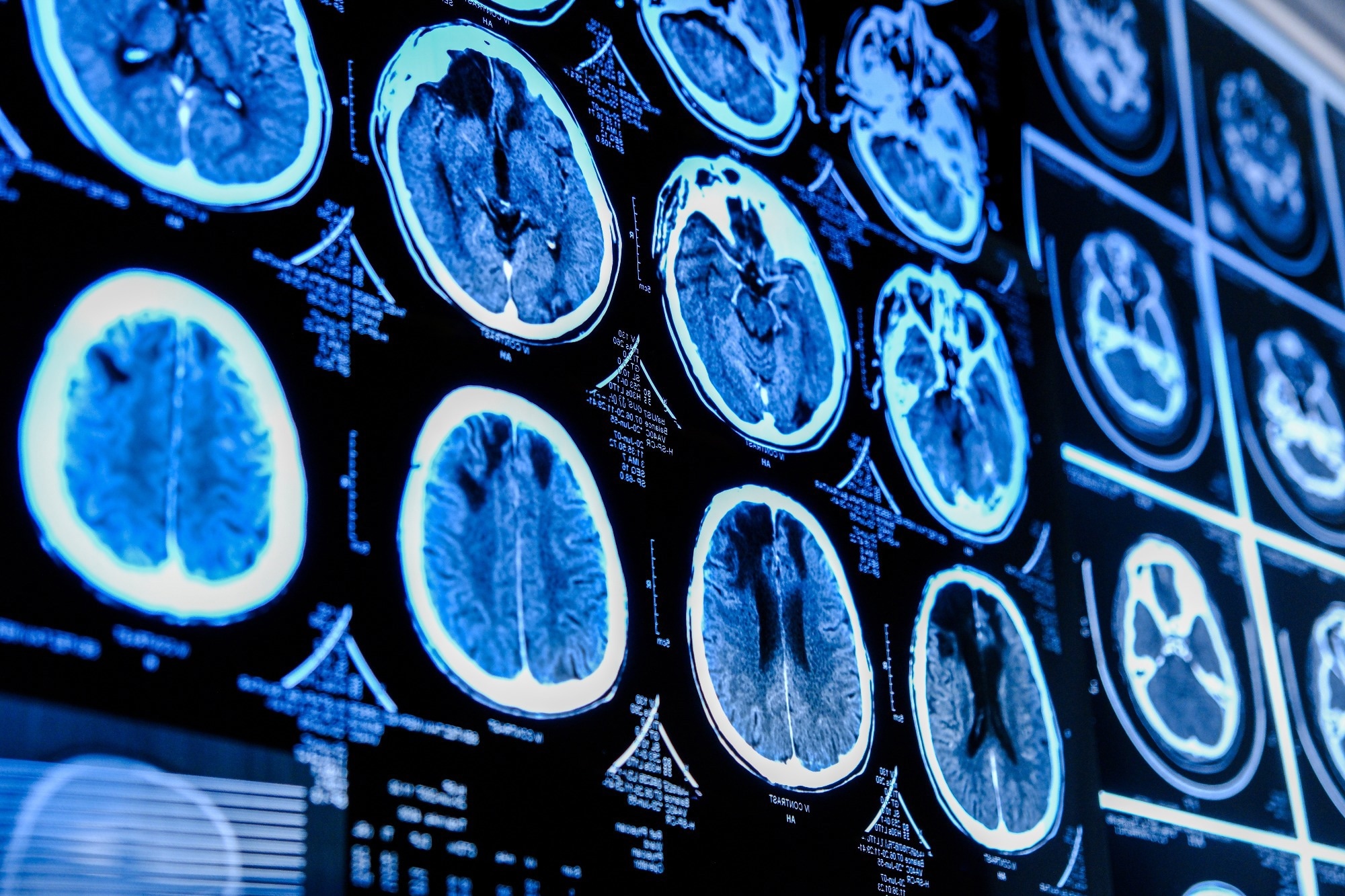 Study: Microstructural brain tissue changes contribute to cognitive and mood deficits in adults with type 2 diabetes mellitus. Image Credit: Elif Bayraktar / Shutterstock.com