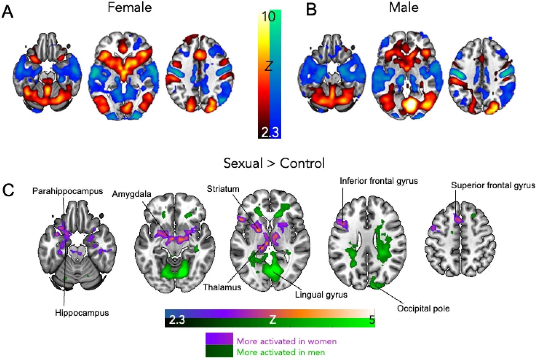 Women with HSDD have greater limbic activation to sexual videos than men. (A) The female and (B) male HSDD group average results showing the brains activation (red/yellow) and deactivation (blue green) to sexual compared to control (exercise) videos. (C) Brain regions more activated in women (relative to men) to sexual compared to control videos are shown in purple. Brain regions more activated in men (relative to women) to sexual compared to control videos are shown in green. Results are cluster corrected and thresholded to Z = 2.3, P < 0.05, N = 64 (32 women, 32 men). Study: Women with HSDD have greater limbic activation to sexual videos than men. (A) The female and (B) male HSDD group average results showing the brains activation (red/yellow) and deactivation (blue green) to sexual compared to control (exercise) videos. (C) Brain regions more activated in women (relative to men) to sexual compared to control videos are shown in purple. Brain regions more activated in men (relative to women) to sexual compared to control videos are shown in green. Results are cluster corrected and thresholded to Z = 2.3, P < 0.05, N = 64 (32 women, 32 men). Study: Women and men with distressing low sexual desire exhibit sexually dimorphic brain processing