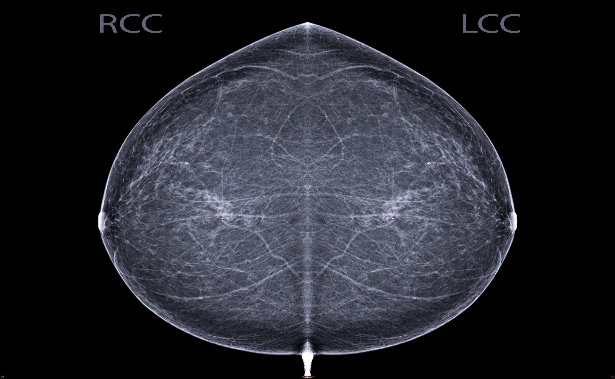 Early Indicators of the Impact of Using AI in Mammography Screening for Breast Cancer