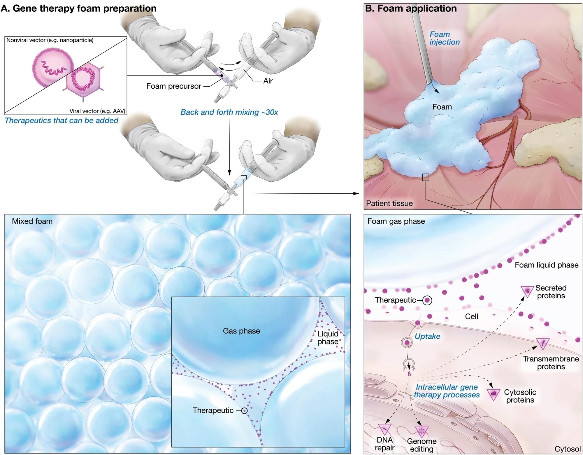 Schematic illustration depicting how gene therapy foam is freshly prepared and applied therapeutically to supply new genetic material or change existing DNA in cells. A Nonviral or viral vector (Therapeutic) is added to foam precursor in a syringe connected to a second syringe filled with air. The air and foam precursor are mixed by vigorously drawing the syringe plungers back and forth at least 30 times, creating a uniform microfoam consisting of gas bubbles separated by a network of interconnected liquid film structures called lamellae. Gene therapy vectors are concentrated in this liquid phase as the foam matures. B Once applied to tissue, the foam gradually deploys its therapeutic cargo and either supplies new genetic material or changes the endogenous DNA in the target cell. Study: Liquid foam improves potency and safety of gene therapy vectors